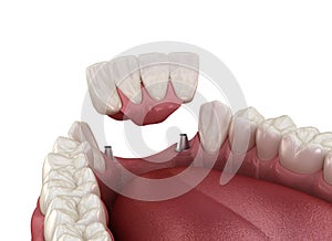 Frontal teeth bridge supported by implants. Medically accurate 3D animation of dental concept