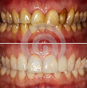 Frontal teeth before and after restoration. Big Smile