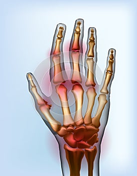 Frontal view image sore osteoarthritis joints of bones the of hand. photo
