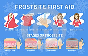 Frostbite first aid infographic. Hypothermia in cold winter
