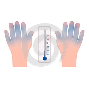 Frostbite hands and thermometer icon vector