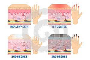 Frostbite stages. Frostbitten finger, hypothermia in cold season photo