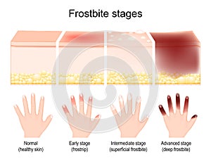 Frostbite stages. skin injury after freezing