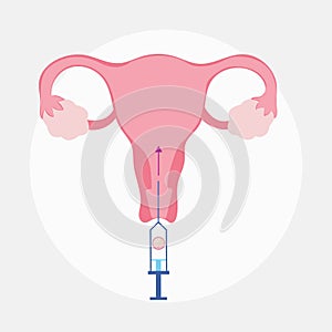 Frozen Embryo Transfer concept illustration