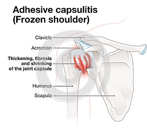 Frozen shoulder. Adhesive capsulitis. Illustration_5 photo