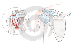 Frozen Shoulder Adhesive capsulitis Illustration. Labeled