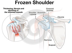 Frozen Shoulder Adhesive capsulitis Illustration. Labeled