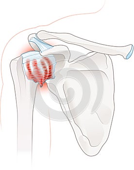 Frozen shoulder. Adhesive capsulitis. Labeled Illustration