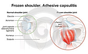 Frozen shoulder. Adhesive capsulitis surgery. Labeled Illustration