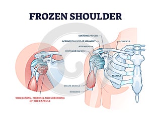 Frozen shoulder condition or adhesive capsulitis syndrome outline diagram