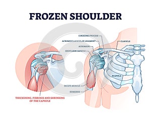 Frozen shoulder condition or adhesive capsulitis syndrome outline diagram photo