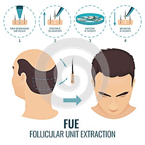 FUE hair loss treatment photo
