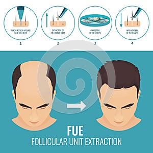 FUE hair loss treatment photo