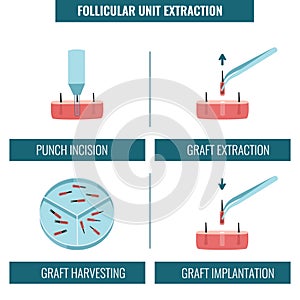 FUE hair transplantation procedure stages medical infographics