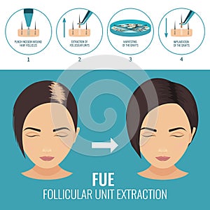 FUE treatment for women photo