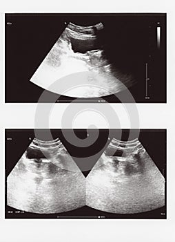 Full abdomen ultrasound sonogram photo