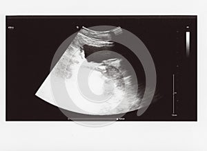 Full abdomen ultrasound sonogram photo