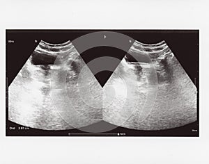 Full abdomen ultrasound sonogram photo