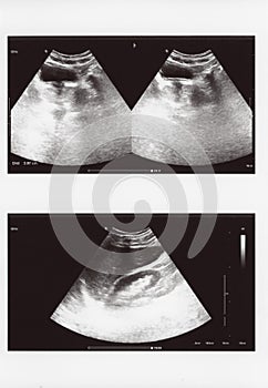 Full abdomen ultrasound sonogram photo