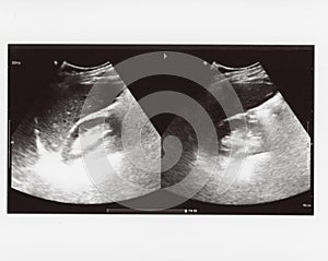 Full abdomen ultrasound sonogram photo