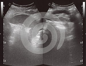 Full abdomen ultrasound sonogram photo