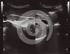 Full abdomen ultrasound sonogram photo