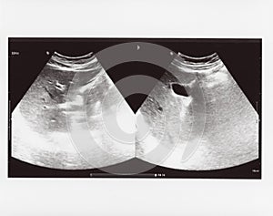 Full abdomen ultrasound sonogram photo