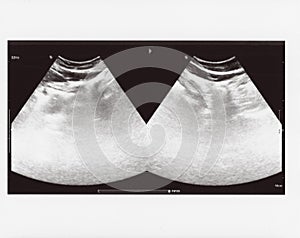 Full abdomen ultrasound sonogram photo