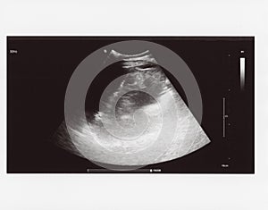 Full abdomen ultrasound sonogram photo