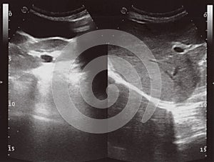 Full abdomen ultrasound sonogram photo