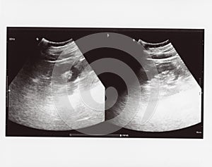 Full abdomen ultrasound sonogram photo