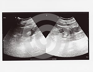 Full abdomen ultrasound sonogram photo