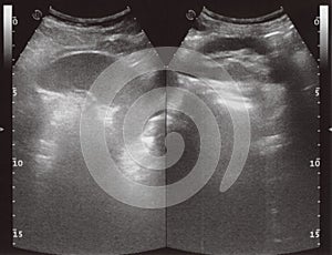 full abdomen ultrasound sonogram photo