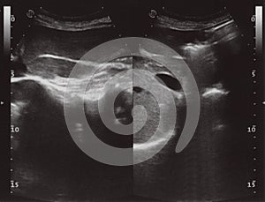 full abdomen ultrasound sonogram photo