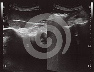 full abdomen ultrasound sonogram photo