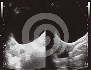 full abdomen ultrasound sonogram photo