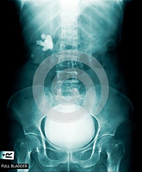 Full bladder x-ray image