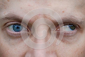 full face macro photo of a man with strabismus and blindness of one eye. visual disability