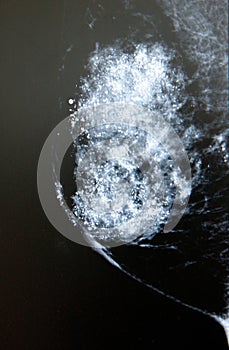 Full-field direct mammography of breast