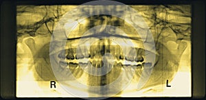 Full mouth dental xray (x-ray)