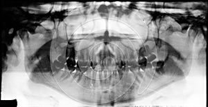 Full mouth dental xray (x-ray)