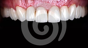 Full mouth teeth made of zircon arch ceramic crowns human teeth of upper veneers of teeth prothesis. Dental restoration treatment