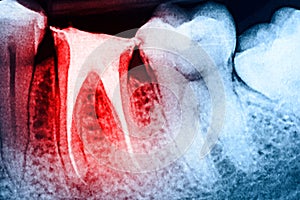 Full Obturation of Root Canal Systems On Teeth