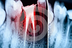 Full Obturation of Root Canal Systems On Teeth