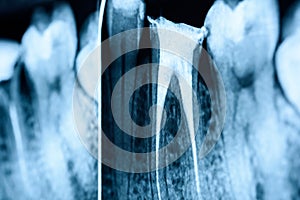 Full Obturation of Root Canal Systems On Teeth photo