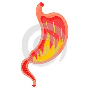 Full stomach. Heaviness of stomach, bloating, pain in the alimentary tract and acid heartburn. Duodenal problems and human organ photo