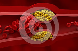 Fully blocked vessel in high level of LDL (bad cholesterol) lipoprotein – Closeup view 3d illustration