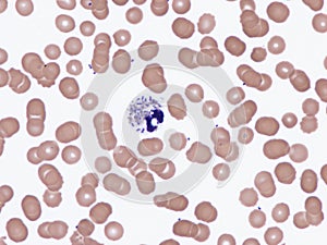 Fulminant pneumococcal sepsis.