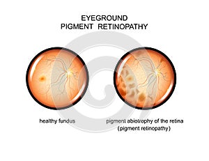 Fundus. pigment retinopathy