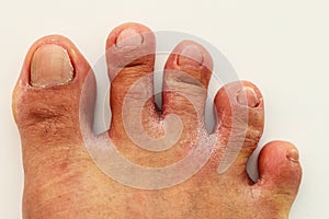 Fungal infection of the area between the toes